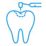 Dental Fillings
