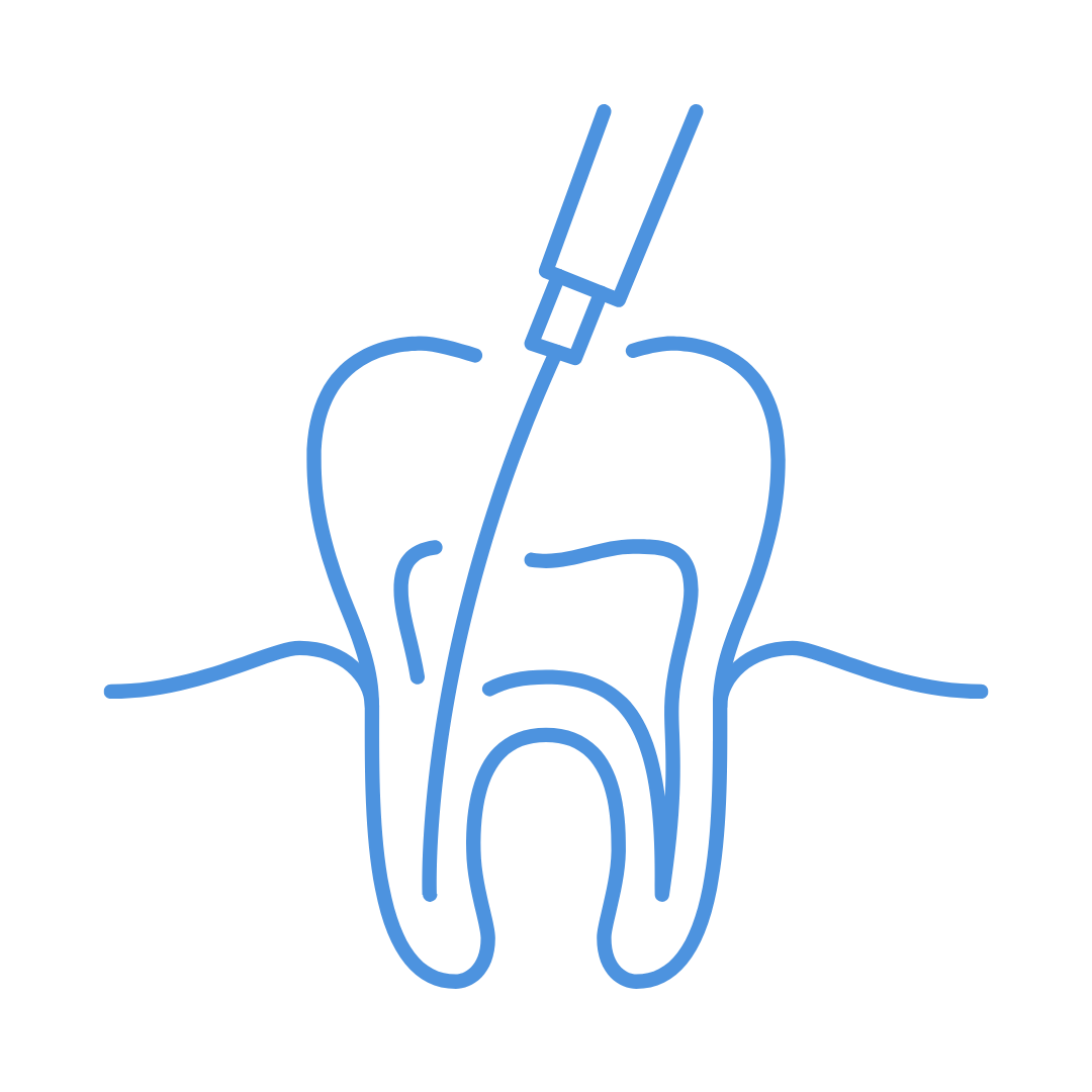 Root Canal Treatment